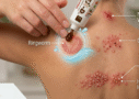 Skin Infections / Dermatitis